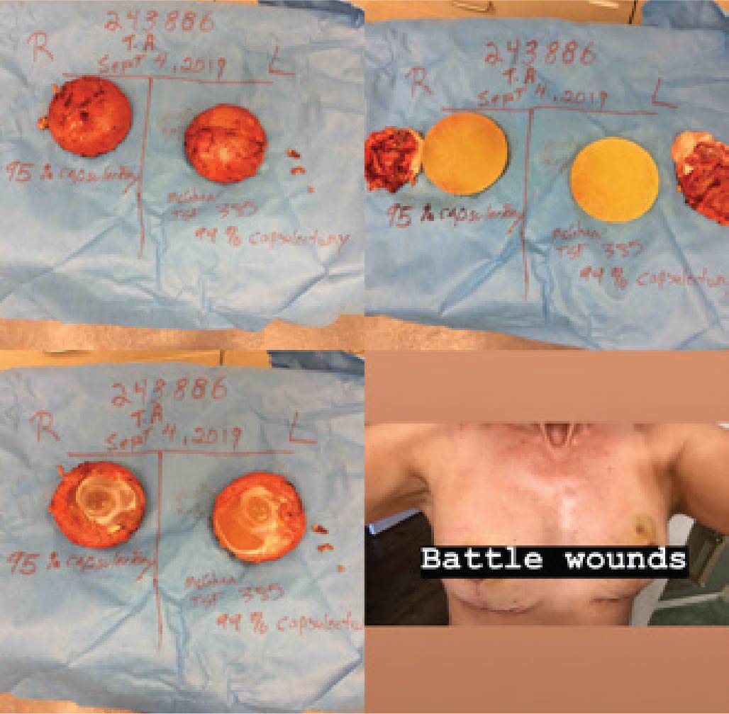 post breast implant removal